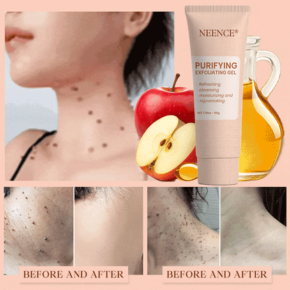 NEENCE® 🔥Purifying Exfoliating Gel for Acanthosis Nigricans, Exfoliation, Dark Spots, Skin Tags, and Eczema_Ultra01